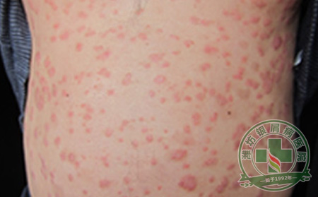 银屑病患者可以带饰品吗?