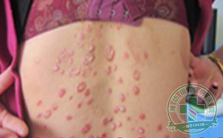 潍坊银屑病医院医生教你“巧”用花露水