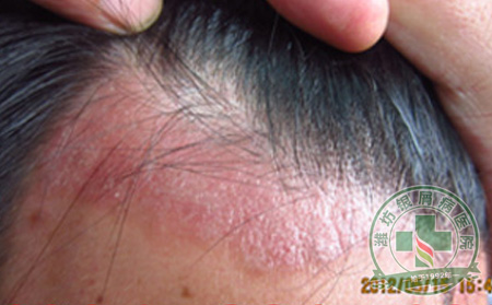 头上长了牛皮癣如何是可以?