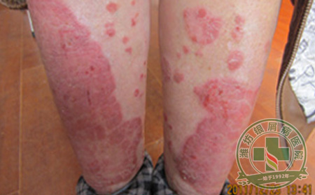 牛皮癣发展到晚期还能治可以吗?