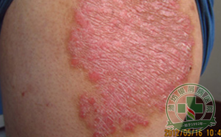 生活中我们应该如何避免银屑病的发生?