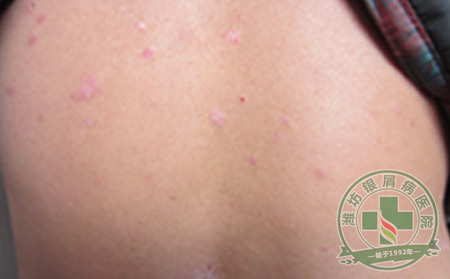 银屑病长在脸上怎么办?