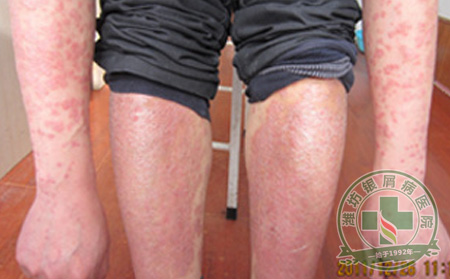 银屑病患者中暑后如何进行急救?