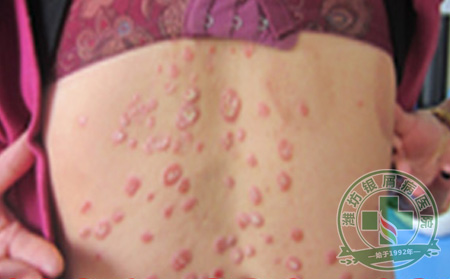 潍坊牛皮癣专科医院剖析牛皮癣诊疗误区