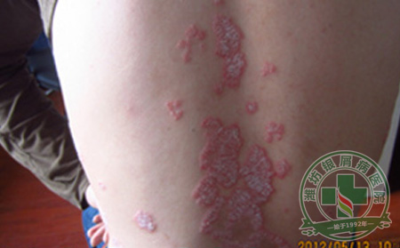 关节型牛皮癣患者护理注意事项