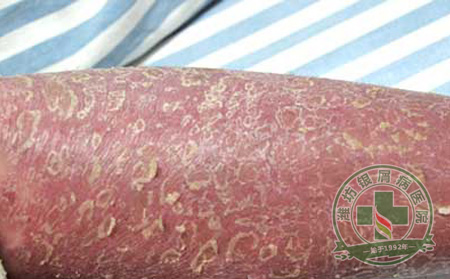 概述红皮型银屑病临床症状