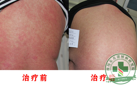 银屑病患者禁忌吃糖