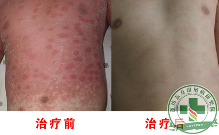 银屑病疾病的危害有哪些