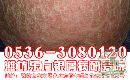 对于红皮型银屑病这种严重的银屑病,患者要注
