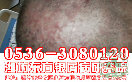 寻常型银屑病发病后患者要怎样注意诊断?