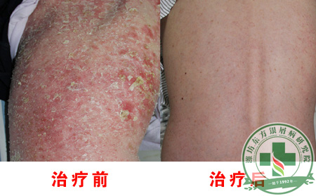 银屑病可以纹身吗