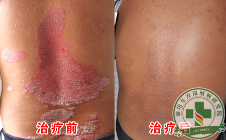怎样预防关节型银屑病