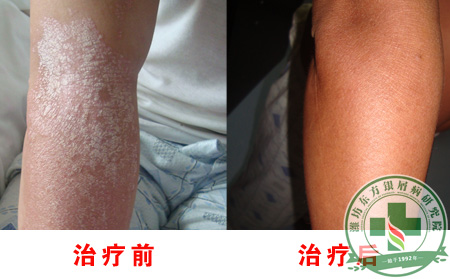 关节型银屑病的危害