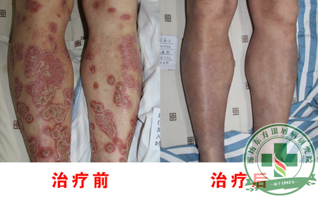 银屑病治疗后会有疤痕吗