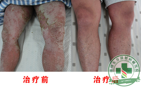 牛皮癣初期症状图片有哪些病因