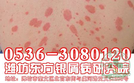 患者对于寻常型牛皮癣的治疗要注意什么问题?