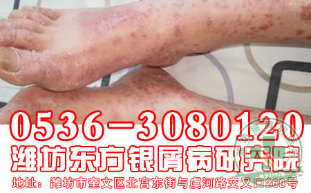 患者对于寻常型牛皮癣的发病应该注意什么?