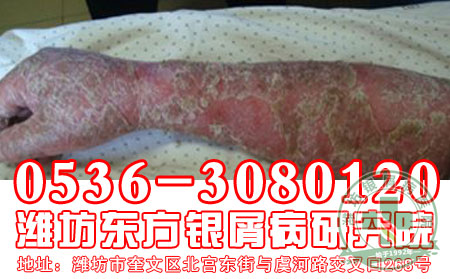红皮型牛皮癣的发病会出现什么危害？