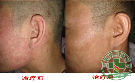 脸上长了银屑病应该怎样治疗？