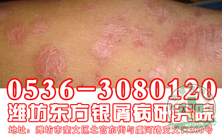寻常型银屑病的预防和护理工作应该做到哪一些