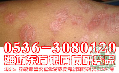 你知道寻常型银屑病的发病因素有哪一些吗?