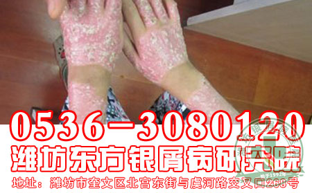 银屑病的保健防护怎样做才 合理？