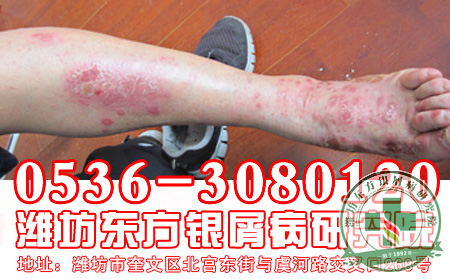 银屑病患者能吃烧烤吗?