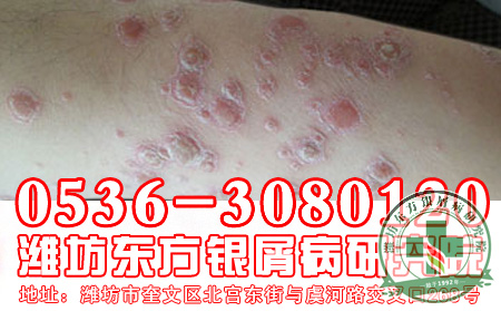 让牛皮癣不再牛!