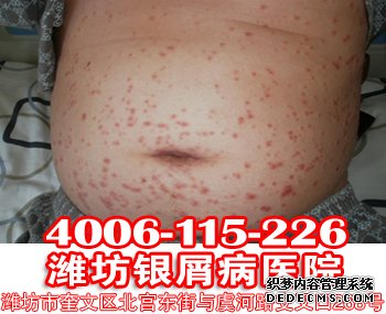 寻常型银屑病怎样护理对于患者 可以?