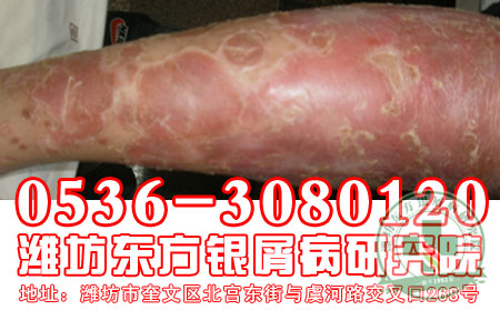 潍坊治疗银屑病 可以的医院——亲，银屑病复发