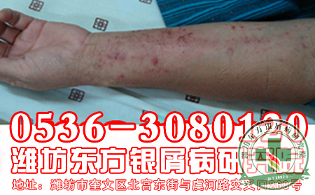 患者如何预防牛皮癣扩散?