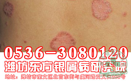 寻常型银屑病的发病,患者要注意什么?