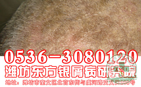 潍坊牛皮癣医院治疗牛皮癣应考虑什么?