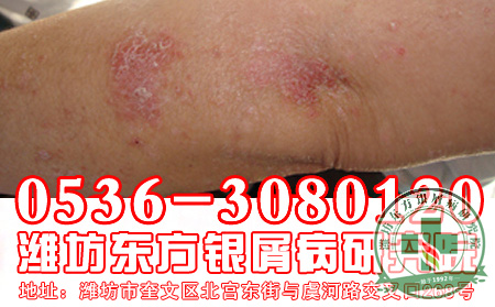 银屑病常见的诱因介绍