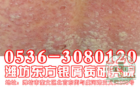 潍坊东方银屑病研究院银屑病多种表现及症状
