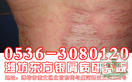 潍坊牛皮癣寻常型牛皮癣病因的介绍