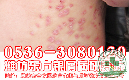 医生教你未雨绸缪,做可以银屑病预防