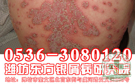 潍坊牛皮癣专科医院——冬季如何预防牛皮癣?