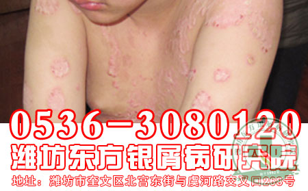 潍坊东方银屑病研究院患者吃花生有什么可以处?