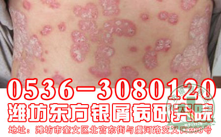 银屑病发病后会出现什么症状表现?