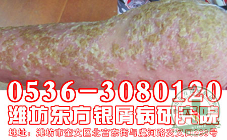 潍坊牛皮癣医院——医生探讨：牛皮癣患者如何