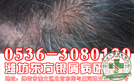 头部银屑病治疗有何良策?