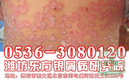 对于银屑病的出现,你知道原因有哪些吗?-潍坊