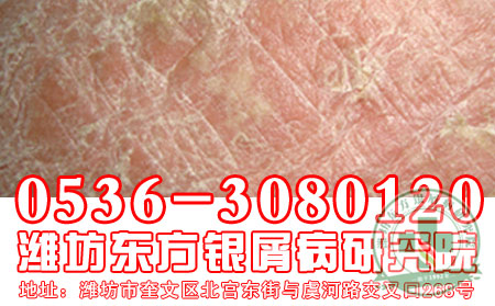 潍坊牛皮癣——治病要选正规医院