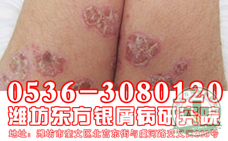 潍坊牛皮癣医院——医生浅谈:牛皮癣护理方法