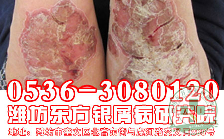 潍坊治疗银屑病 可以医院患者怎样摆脱忧郁心情