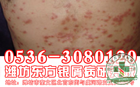 儿童银屑病护理有何良策？