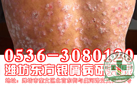 银屑病患者病情突然恶化怎么办?