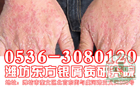 潍坊牛皮癣专科医院患者吃冷饮莫贪多!