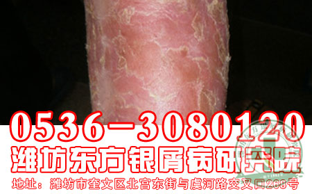 潍坊银屑病医院：红皮型银屑病病因介绍